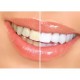 EZGO Profesional brillante sonrisa blanca Inicio Blanqueamiento de dientes Kit de 35% de peróxido de carbamida con 4 piezas jer