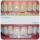 Profesional Dental Fuerza 16% Gel de blanqueamiento de dientes. Incluye 4 jeringas de 10cc XL de gel blanqueador- Aprobado por