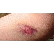 QUITAR HEMATOMA