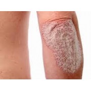 PSORIASIS